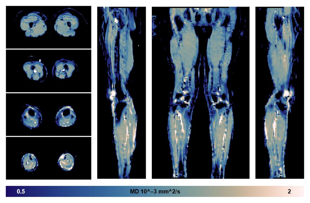 IVIM corrected whole leg muscle mean diffusivity obtained from diffusion tensor imaging.